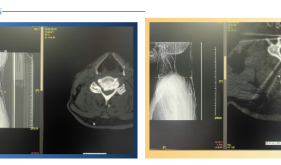看茂医丨显微镜下颈椎微创手术助两高风险患者重获新生