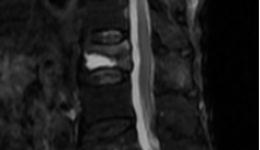 百岁老人告别腰痛，医生：早诊早治是关键！