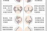 茂医专家提醒：乳腺结节正年轻化，这些信号千万别忽视