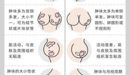 茂医专家提醒：乳腺结节正年轻化，这些信号千万别忽视