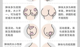 茂医专家提醒：乳腺结节正年轻化，这些信号千万别忽视