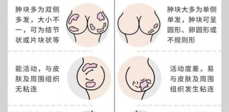 茂医专家提醒：乳腺结节正年轻化，这些信号千万别忽视