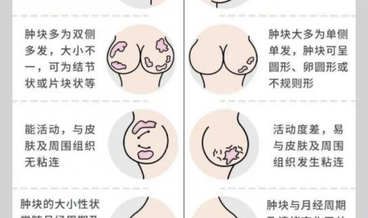 茂医专家提醒：乳腺结节正年轻化，这些信号千万别忽视