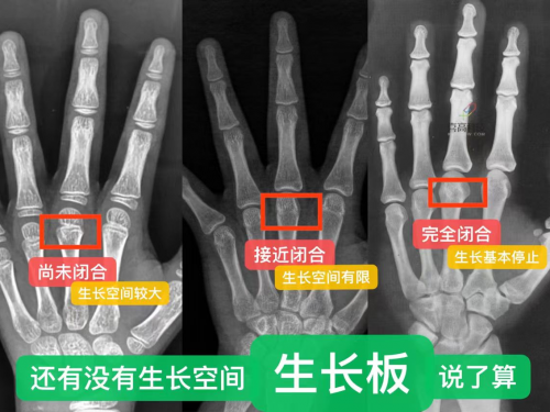 中西医协同、AI辅助...儿童身高“助长”有新招？茂医专家解答→