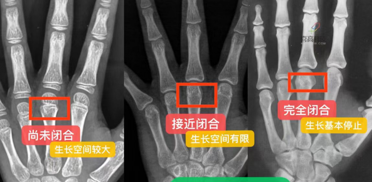 中西医协同、AI辅助...儿童身高“助长”有新招？茂医专家解答→
