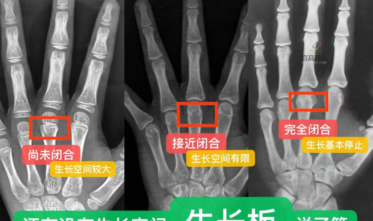 中西医协同、AI辅助...儿童身高“助长”有新招？茂医专家解答→