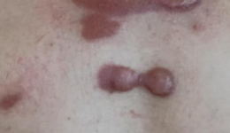 小科普大健康丨瘢痕疙瘩与磷-32小贴片的“秘密”