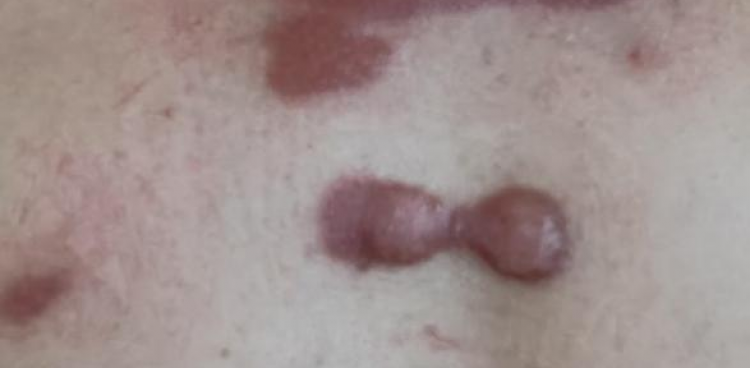 小科普大健康丨瘢痕疙瘩与磷-32小贴片的“秘密”