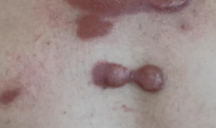 小科普大健康丨瘢痕疙瘩与磷-32小贴片的“秘密”