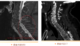 看茂医丨颈胸椎“拆弹”成功 七旬老人竖拇指点赞