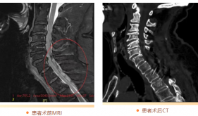 看茂医丨颈胸椎“拆弹”成功 七旬老人竖拇指点赞