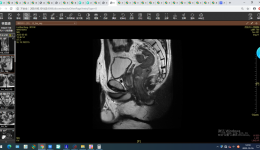 多学科协作“拆弹” 助力晚期局部直肠腺癌患者迎来生机